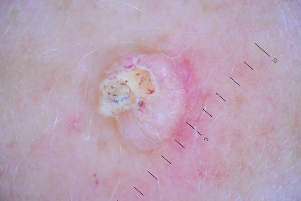 The stage of development of aging warts - skin horns