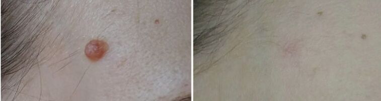 Before and after laser papilloma removal Figure 2