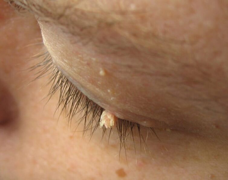 papilloma on the eyelid