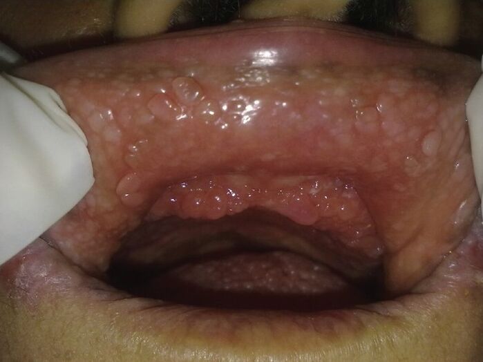 papillomas in the mouth