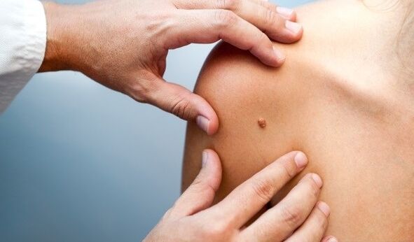 how to remove warts on shoulder