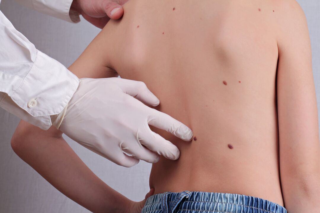 A dermatologist conducts a clinical examination of a patient with papilloma on the body
