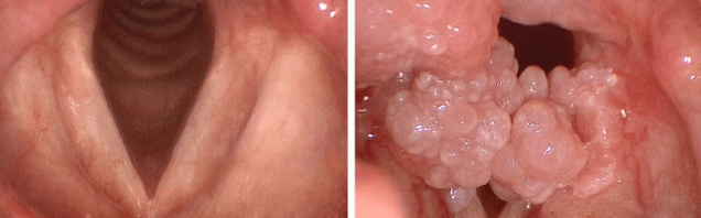 Papiles in the mouth