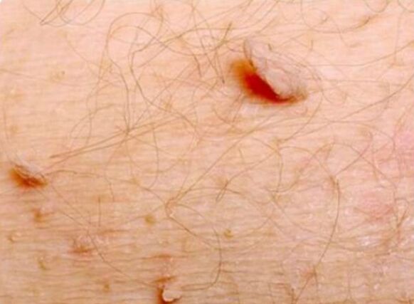 Sharp papiles in the human body