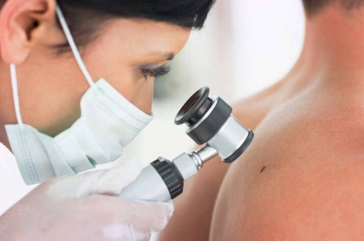 The doctor examines the papilloma
