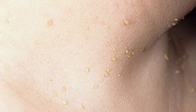 The risk of developing papillomatosis on the neck