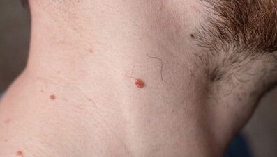 Why papillomas appear on the neck