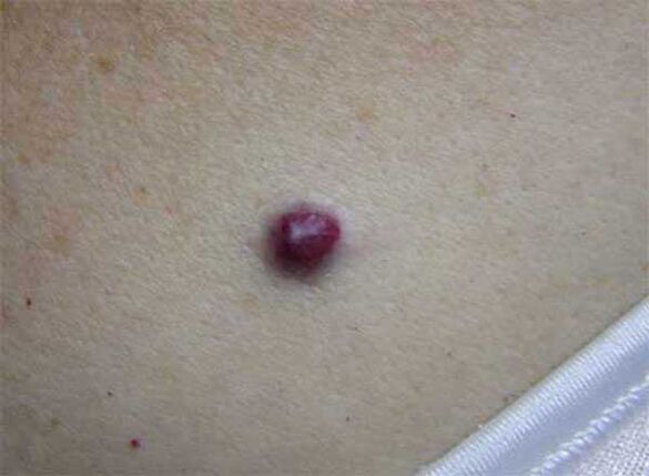 red mole on the body