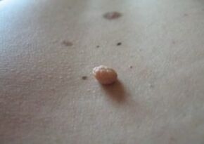 A papilloma is a growth on the surface of the skin