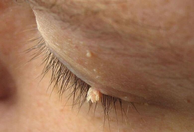 filamentous wart on eyelid