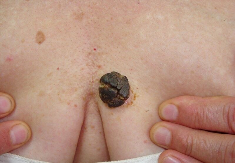 keratoma in the human body