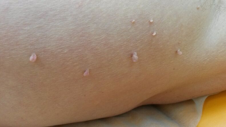 papillomas in the human body
