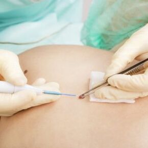surgical removal of papillomas