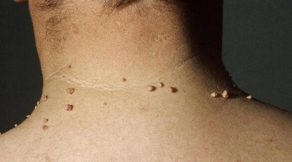 filiform papilloma on the neck