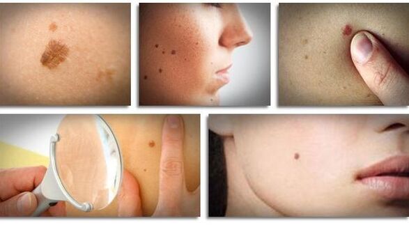 types of viral papilloma in the body