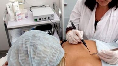 As the method of eliminating electrocoagulation warts