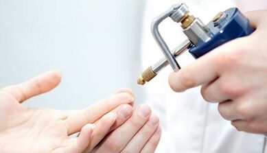 Cryodeestrion Warts as a treatment method