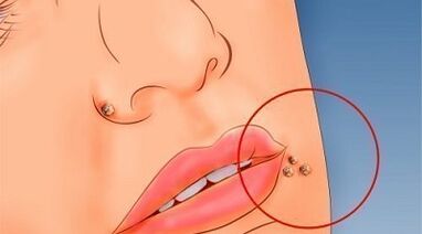 Reasons for the appearance of warts